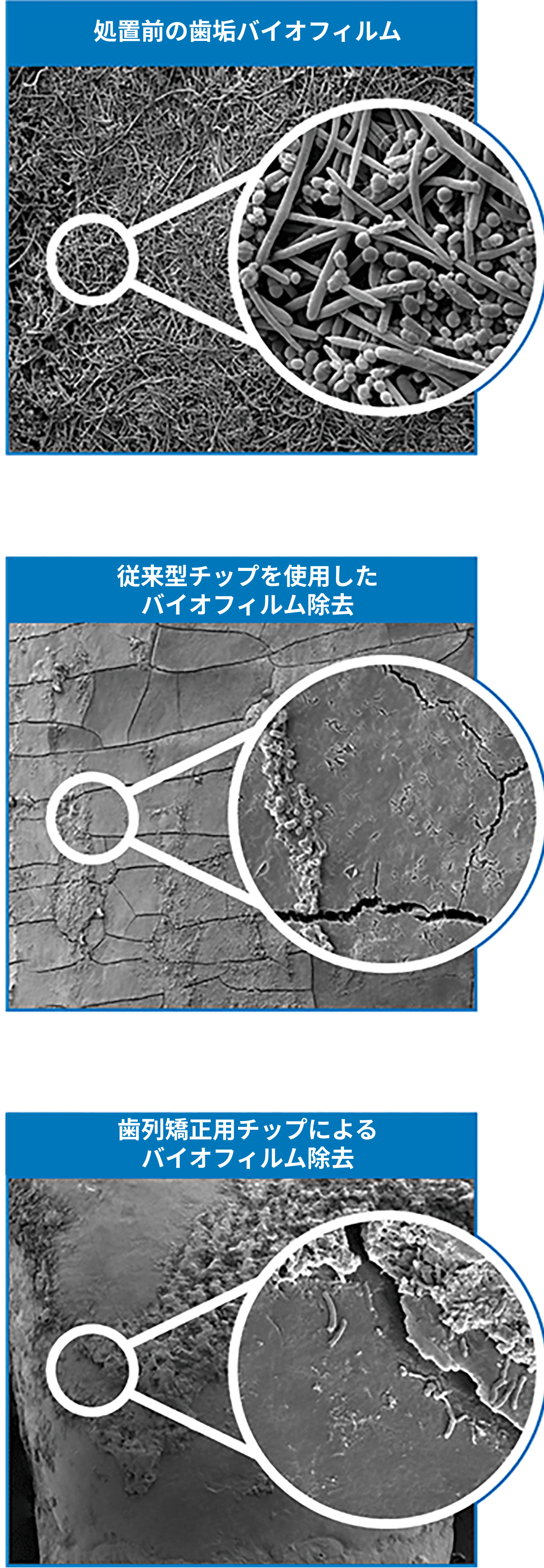 Waterpik™ウォーターフロッサーによるプラーク除去効果:電子顕微鏡による評価研究