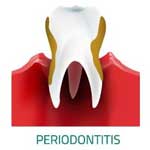 歯周炎:症状、原因、治療方法