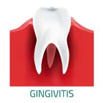 歯肉炎:症状、原因、治療法