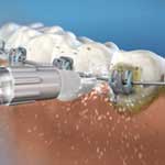 ウォーターフロッサーを使った矯正器具のフロス方法