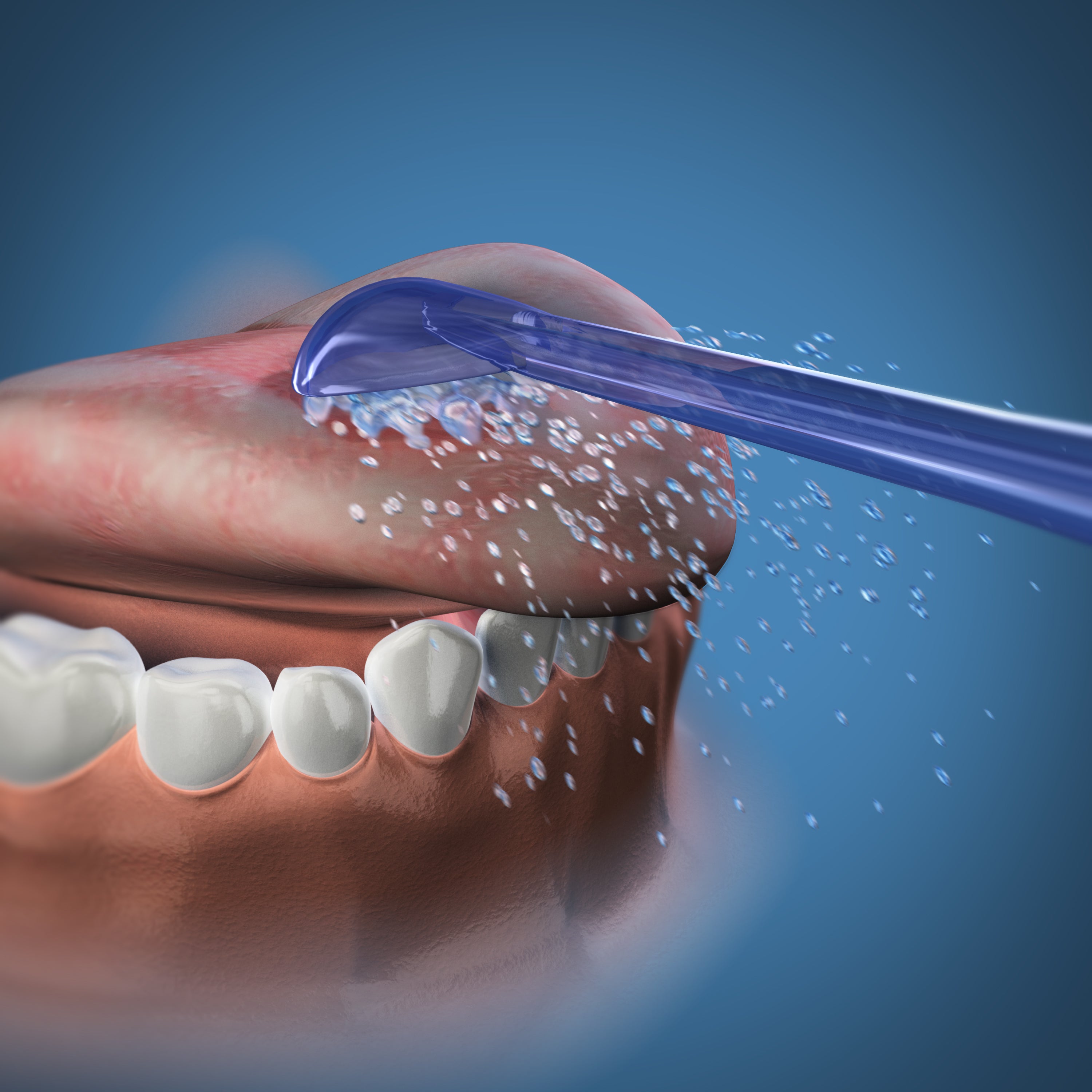 舌クリーナーチップ